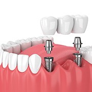 illustration implant dental bridge in Fairfax  