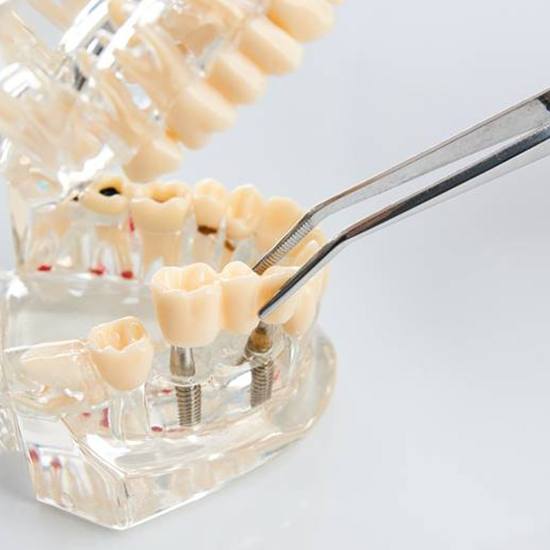 Dentist placing restoration onto model of dental implant in Fairfax