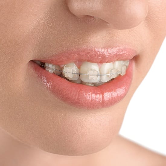 Woman with six months smiles clear braces