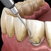 A CGI of scaling and root planing treatment