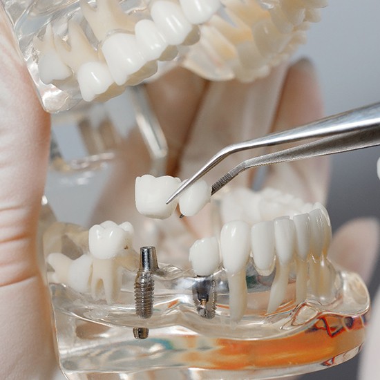 Dentist placing restoration for dental implants in Fairfax