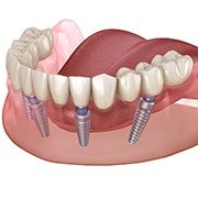 Diagram of dental implants in Fairfax holding a denture