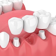 illustration traditional dental bridge in Fairfax  