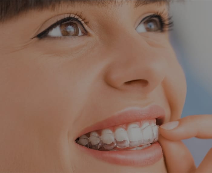 Close up of woman putting Invisalign tray into her mouth