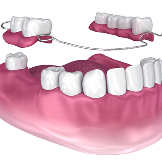 partial dentures