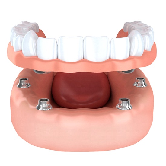 implant dentures