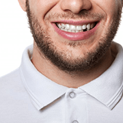 a man smiling while missing a single tooth