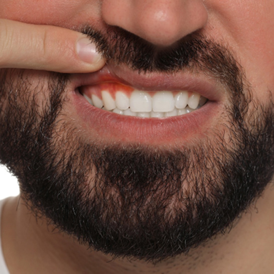 Patient pulling up lip to show gum disease