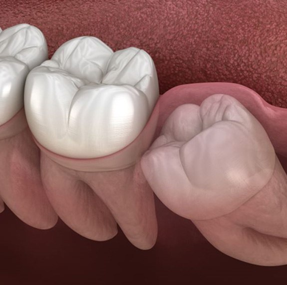 Illustration of impacted wisdom tooth