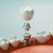 A digital image of a single tooth dental implant in Fairfax