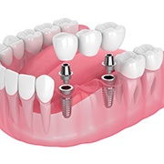 A digital image of an implant bridge replacing multiple missing teeth in Fairfax