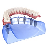 A digital image of a lower arch with 8 dental implants in Fairfax and a full denture