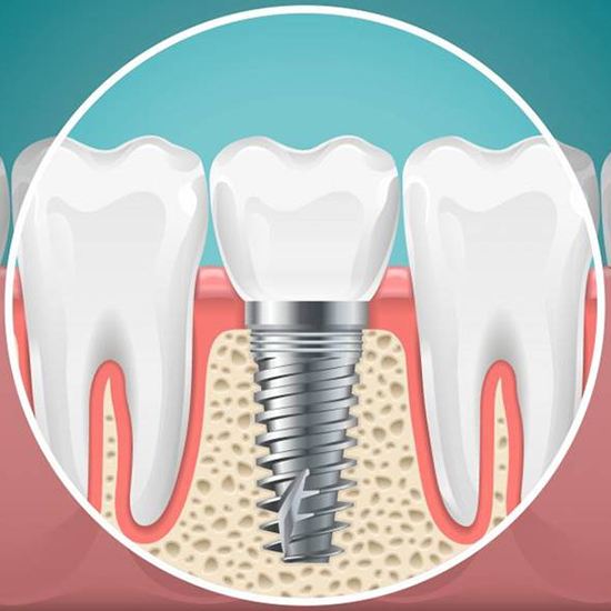 Diagram of an integrated dental implant in Fairfax