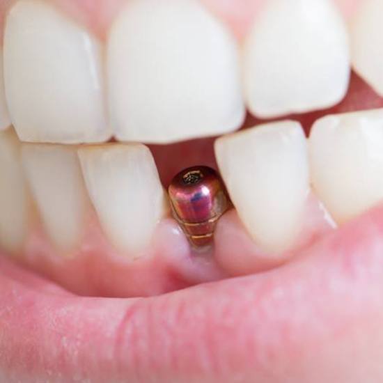 Closeup of an integrated dental implant in Fairfax