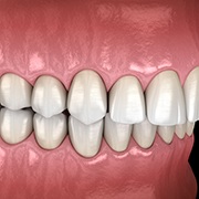 Illustration of an overbite