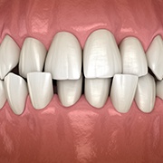Illustration of a crossbite