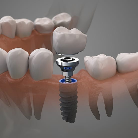 Animated dental implant supported replacement tooth