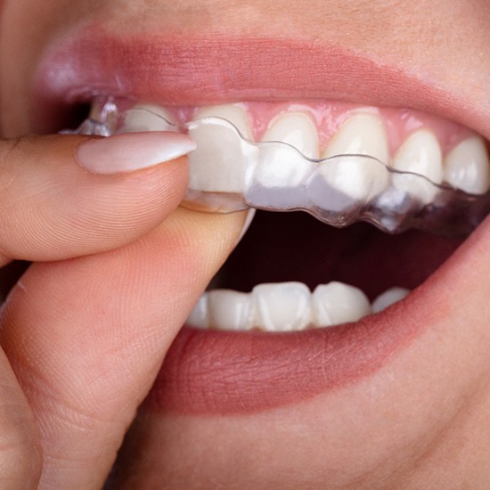 A young person attempting to insert their clear aligners in Fairfax