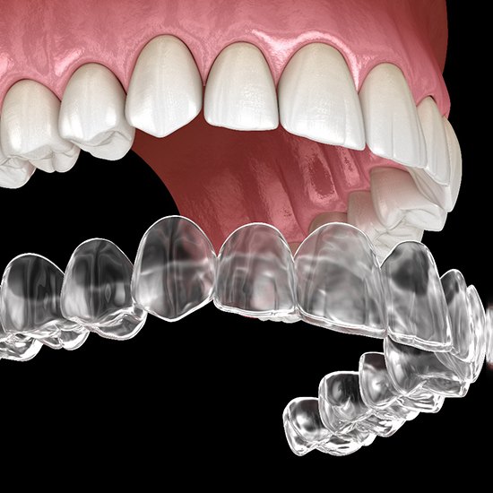 A three-dimensional model of clear aligners in Fairfax
