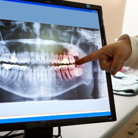 Digital dental x-rays on computer screen