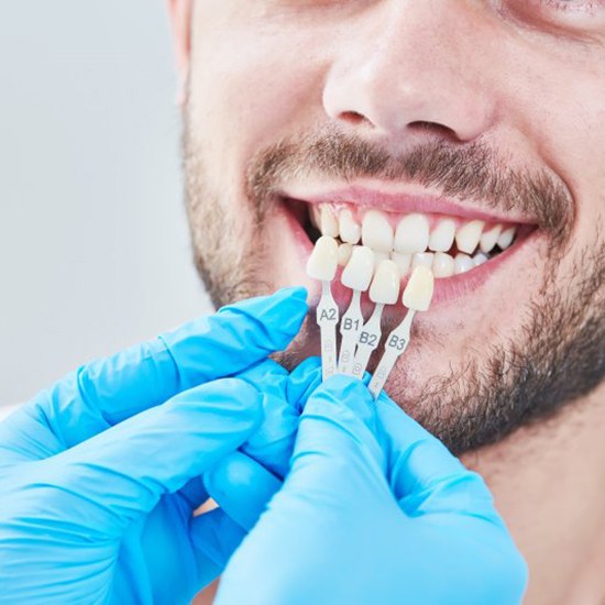 dentist holding veneers to a patient’s smile 