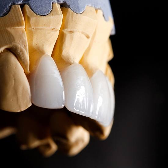 a plaster model of a mouth with veneers placed on it