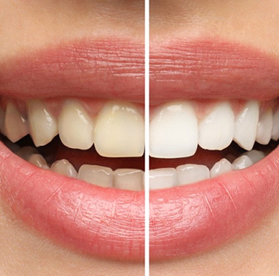 Closeup of patient's smile before and after teeth whitening