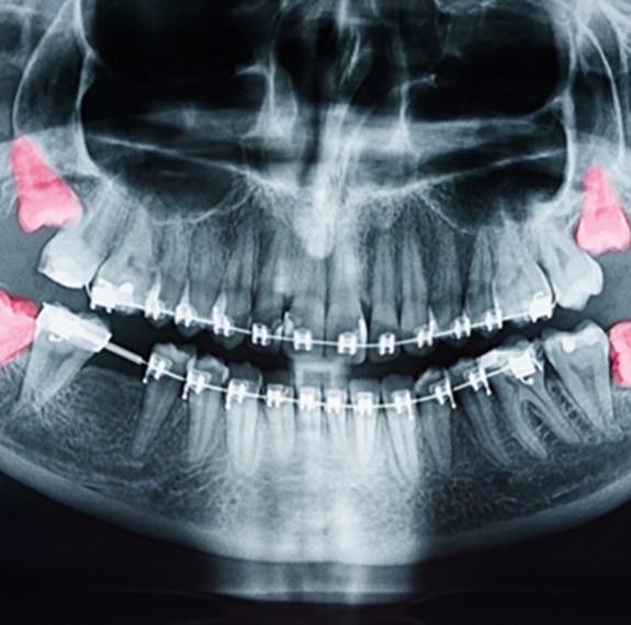 X-ray with position of wisdom teeth highlighted in red