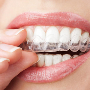 Invisalign® Clear Aligners vs Traditional Metal Braces: Which is