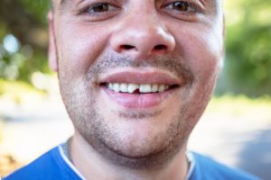 a man showing his chipped front tooth