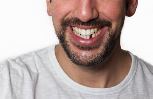 Man with a missing lower tooth
